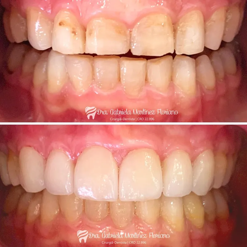 Antes e depois de prótese frontal — Dra. Gabriela Martinez Floriano | CRO 22.996