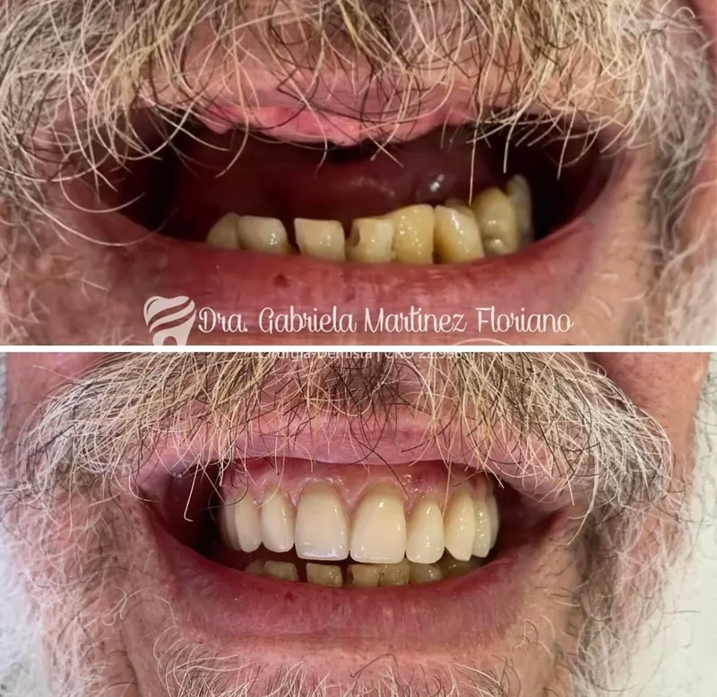 Antes e depois de reabilitação estética — Dra. Gabriela Martinez Floriano | CRO 22.996